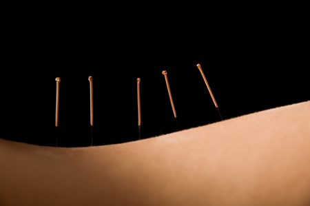 Acupuncture process